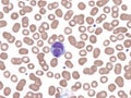 Splenic marginal lymphoma with circulating binucleated lymphocytes. Royalty Free Stock Photo