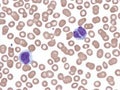 Splenic marginal lymphoma with circulating binucleated lymphocytes. Royalty Free Stock Photo