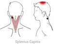Splenius Capitis: Treating crown headaches caused by Splenius capitis trigger points Royalty Free Stock Photo