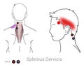 Managing upper shoulder and side headaches pain caused by myofascial trigger points in the Splenius Cervicis muscle