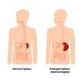 Splenomegaly of the spleen. Enlargement of the spleen. Vector illustration on isolated background