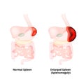 Splenomegaly of the spleen. Enlargement of the spleen. Vector illustration on isolated background