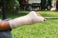 Splint broken bone hand Injured Royalty Free Stock Photo