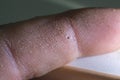 a splinter in a person& x27;s finger