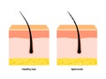 Split and normal hair