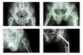 Spondylolisthesis