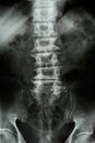 Spondylosis