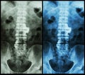 Spondylosis ( film x-ray lumbo - sacral spine : show spondylosis at L2-3 )