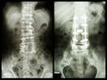 Spondylosis (Left image) , Patient was operated and internal fixed. (Right image)