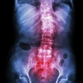 Spondylosis and Scoliosis ( film x-ray lumbar - sacrum spine show crooked spine ) ( old patient ) ( Spine Healthcare ) Royalty Free Stock Photo