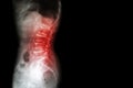 Spondylosis , Spondylolisthesis ( Film x-ray lumbo - sacral spine show spine collapse , decrease in disc space , bony spur format Royalty Free Stock Photo