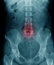 Spondylosis x-ray image, x-ray image