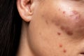 Spots on the skin. Close up of a man with acne on his face, studio shot. Royalty Free Stock Photo