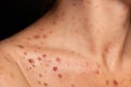 Spots on the skin. Close up of a man with acne on his face, studio shot. Royalty Free Stock Photo