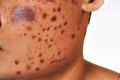 Spots on the skin. Close up of a man with acne on his face, studio shot. Royalty Free Stock Photo