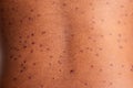 Spots on the skin. Close up of a man with acne on his face, studio shot. Royalty Free Stock Photo