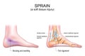 Sprain. A soft tissue injury in the human foot Royalty Free Stock Photo