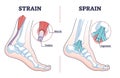 Sprain vs strain anatomical comparison as medical foot injury outline diagram Royalty Free Stock Photo