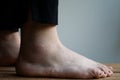 Sprained ankle and foot still a little bit swollen after injury Royalty Free Stock Photo