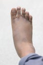 Sprained and swollen ankle. Ankle injury with dislocation and sprains Royalty Free Stock Photo