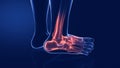 sprains and dislocations to the ankle Royalty Free Stock Photo