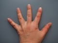 Spread 5 fingers. Female hand with dry atopic skin. White background. Close-up of the skin on the palm and fingers