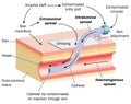 Spread of infection via a cannula