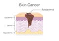 Spreading of Cancer Cell in Human Skin layer.