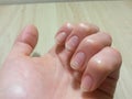 Spring avitaminosis of nails