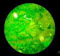 Sputum smear Fluorescence (FM) stain microscopic 40x show plenty of Macrobacterium Tuberculosis bacteria