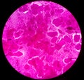 Sputum smear under microscopy showing gram positive cocci bacteria