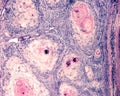 Squamous cell carcinoma of the eyeball