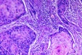 Squamous cell carcinoma of a human Royalty Free Stock Photo