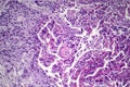 Squamous cell carcinoma of the lung Royalty Free Stock Photo