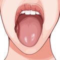 Squamous cell carcinoma is the most common type of tongue cancer.