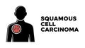 Squamous Cell Carcinoma (SCC) Royalty Free Stock Photo