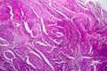 Squamous cell carcinoma of the uterus, light micrograph Royalty Free Stock Photo