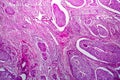Squamous cell carcinoma of the uterus, light micrograph Royalty Free Stock Photo