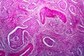 Squamous cell carcinoma of the uterus, light micrograph Royalty Free Stock Photo