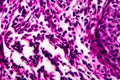 Squamous cell carcinoma of the uterus, light micrograph