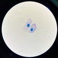 Squamous epithelial cell in sputum AFB