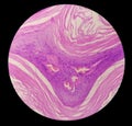 Squamous hyperplasia of Right Lower Bucco Areola