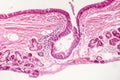 Squamous metaplasia of bronchial epithelium Royalty Free Stock Photo