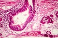 Squamous metaplasia of bronchial epithelium Royalty Free Stock Photo