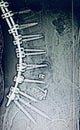 Lumbar spine fusion hardwear stabilization device