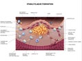 Stable plaque formation, Atherosclerosis