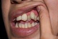 Stacked or overlapping canine teeth of Asian man. Also called crowded teeth Royalty Free Stock Photo