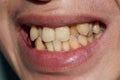 Stacked or overlapping teeth with yellow stain. Also called crowded teeth Royalty Free Stock Photo