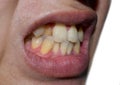 Stacked or overlapping teeth with yellow stain. Also called crowded teeth Royalty Free Stock Photo