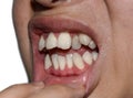 Stacked or overlapping white teeth. Also called crowded teeth Royalty Free Stock Photo